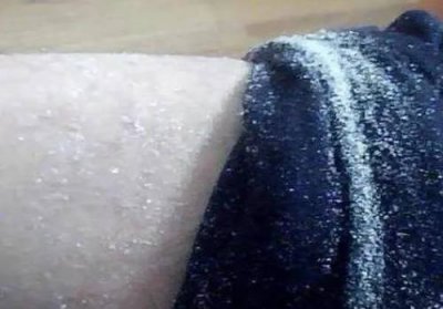 ​冬天秋裤上面满是白色的皮屑？腿上有很多皮屑是怎么回事