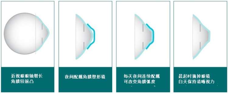 ok镜美国已经禁止了(角膜受损、国外禁用，OK镜真的不OK？)