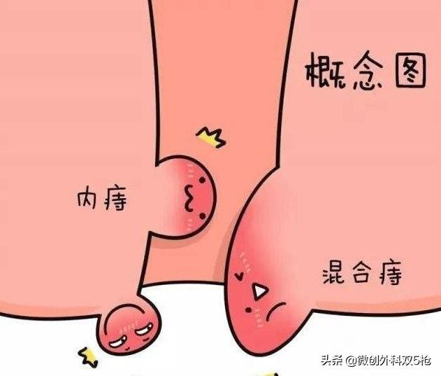 常见真实女性外痔疮图片(教你认识和日常防治痔疮)