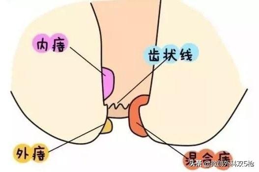 常见真实女性外痔疮图片(教你认识和日常防治痔疮)