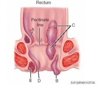 ​常见真实女性外痔疮图片(教你认识和日常防治痔疮)