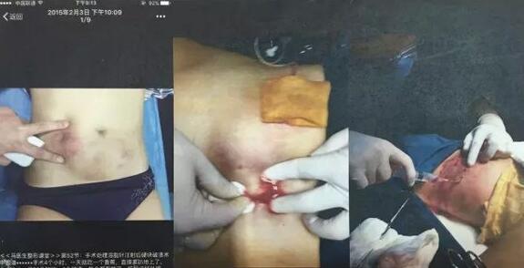 美容院微针骗局(女子注射微商溶脂针险毁容)(6)