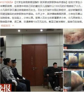 ​美容院微针骗局（女子注射微商溶脂针险毁容）