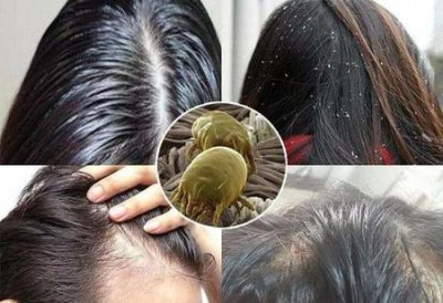 ​头皮上长螨虫的症状