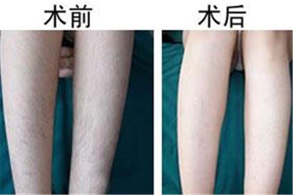 汗毛多吃什么可以变少 汗毛多吃什么 汗毛多吃什么可以变少 汗毛多吃什么