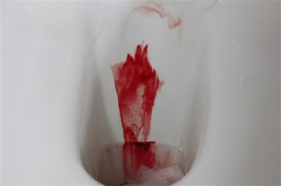 ​肛裂治疗手术，无法言喻的经历