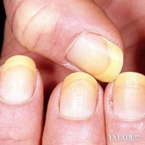 ​剥枇杷指甲变黄怎么办（剥枇杷指甲变黄怎么回事）
